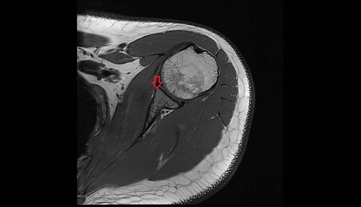 Anterior rim of glenoid mri  anatomy labelled image-img-00000-00000