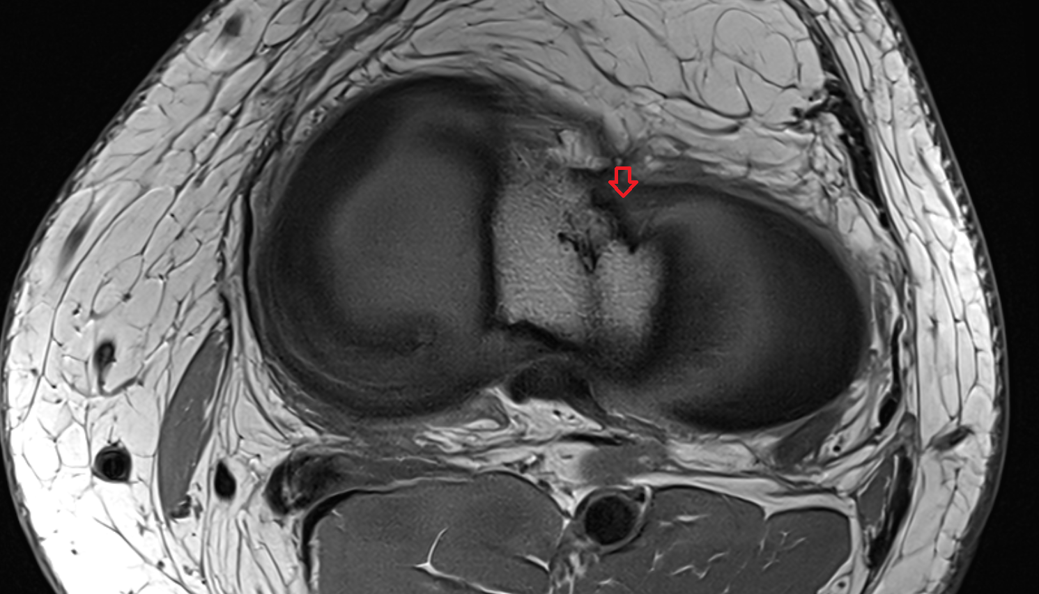 Anterior root of lateral meniscus  axial  cross sectional anatomy 3T MRI AI enhanced  radiology  anatomy image-img-00000-00000