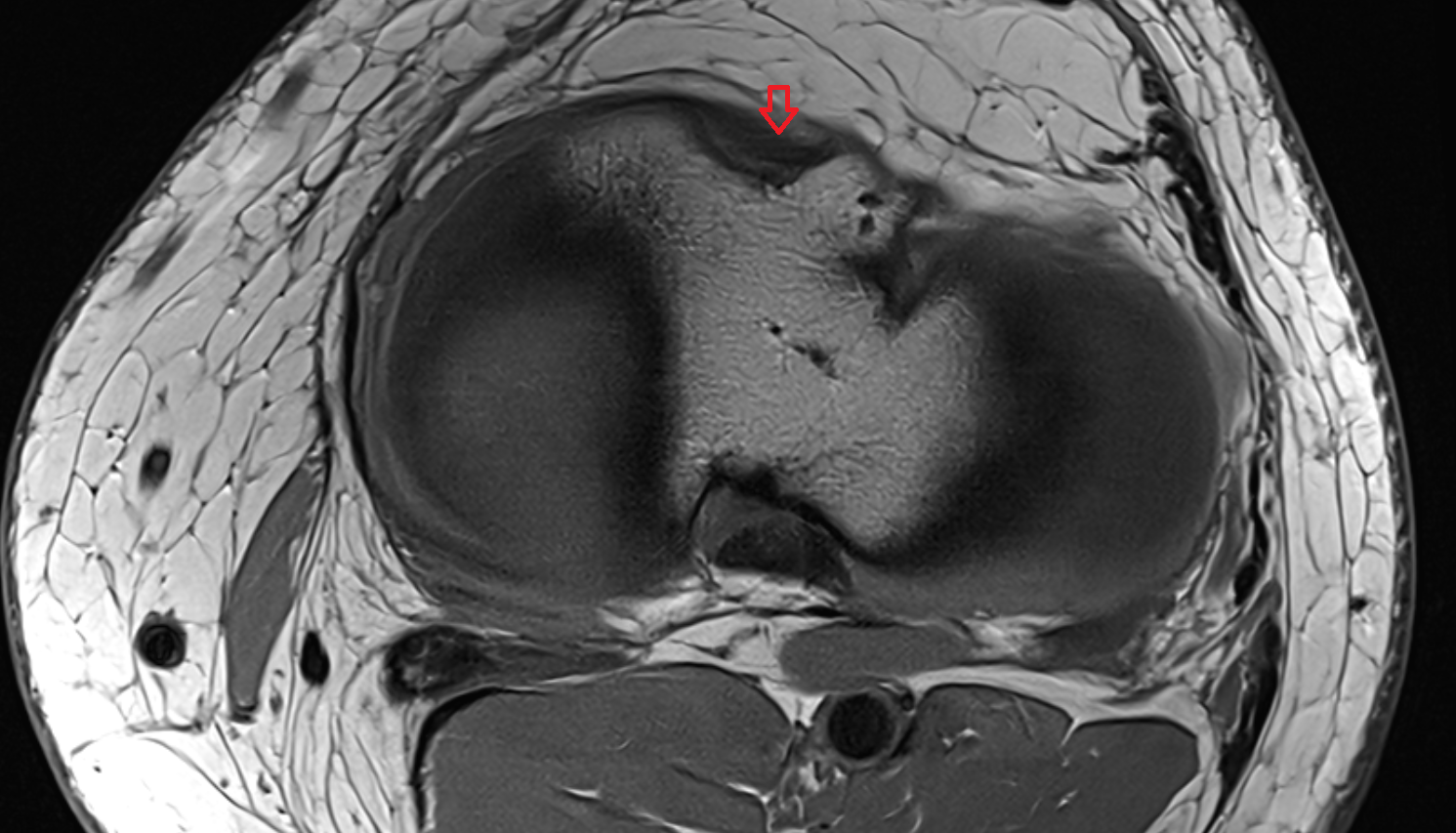 Anterior root of medial meniscus  axial  cross sectional anatomy 3T MRI AI enhanced  radiology  anatomy image-img-00000-00000