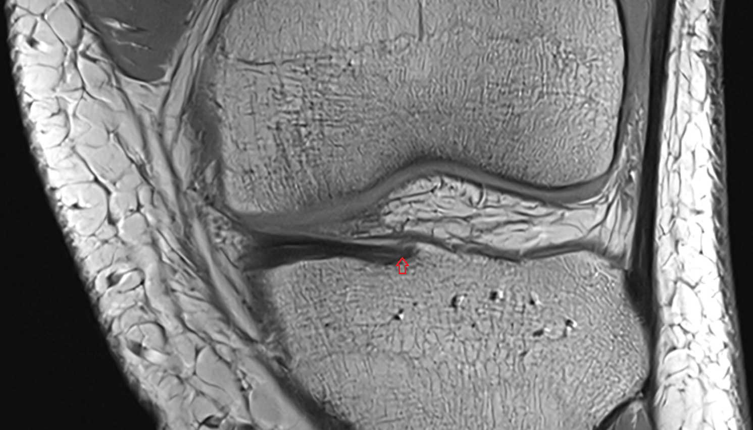 Anterior root of medial meniscus coronal  cross sectional anatomy 3T MRI AI enhanced  radiology  anatomy image-img-00000-00000