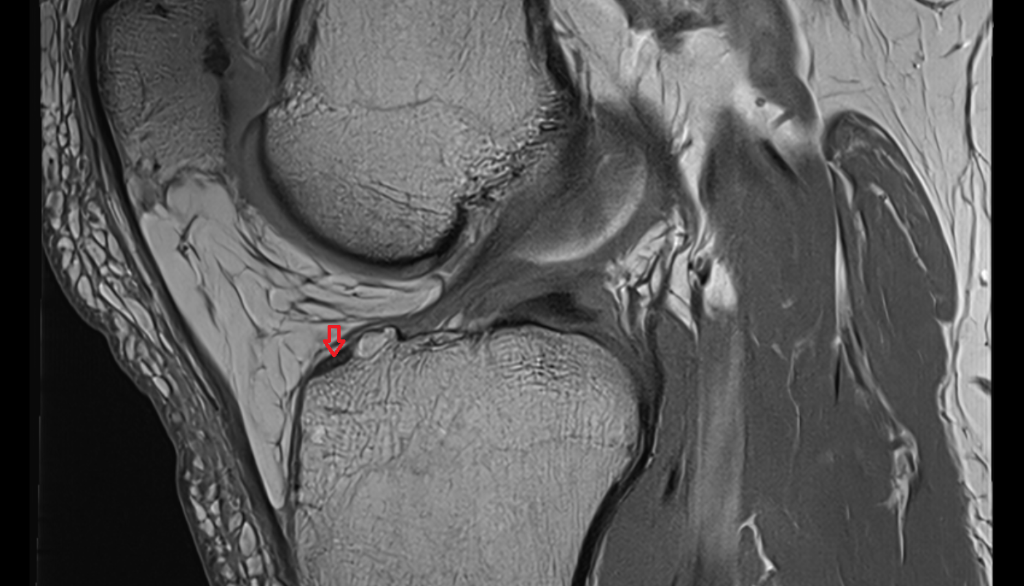 Anterior root of medial meniscus  sagittal  cross sectional anatomy 3T MRI AI enhanced  radiology  anatomy image-img-00000-00000_00001