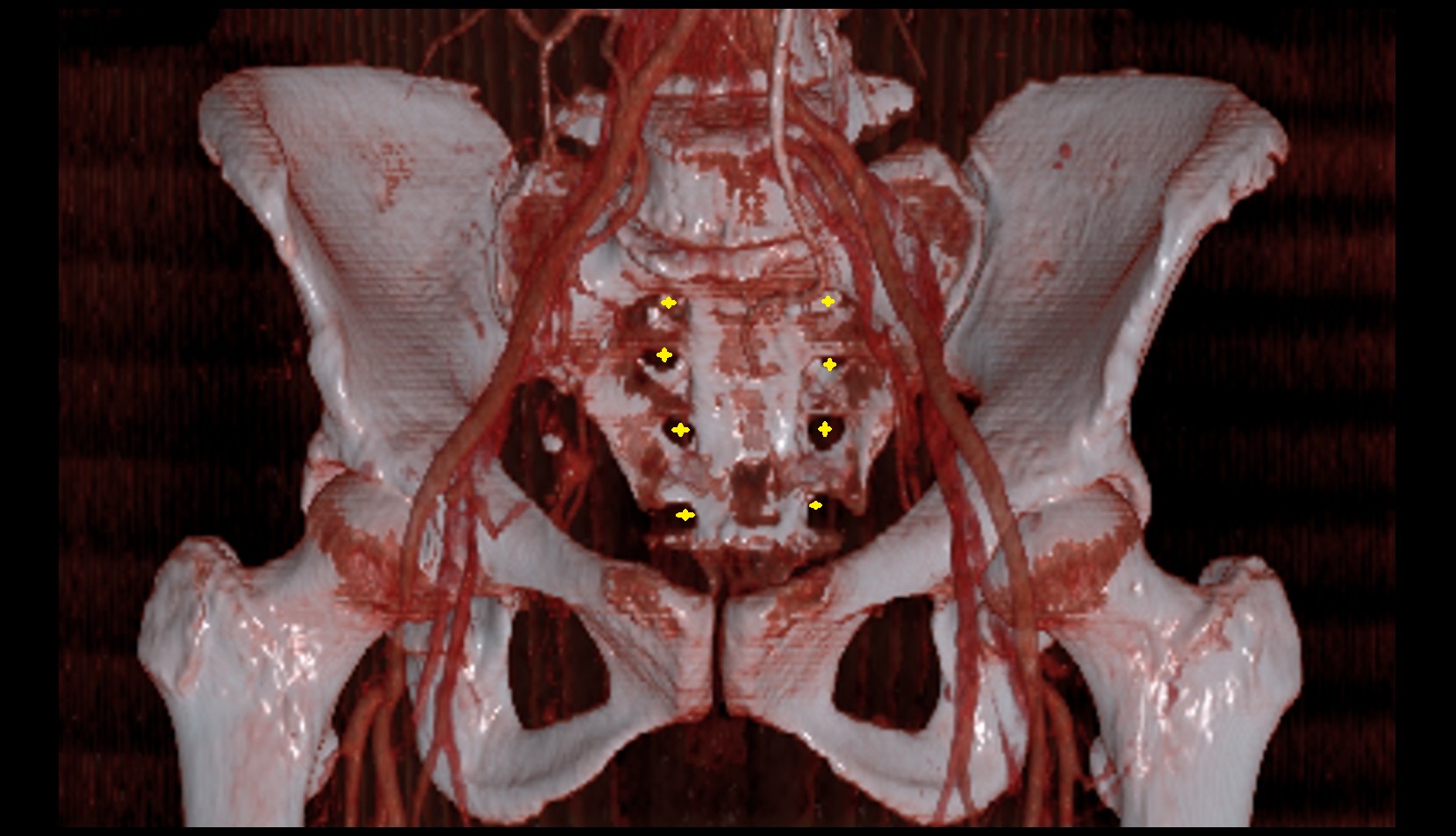 Anterior sacral foramina ct 3d coronal image