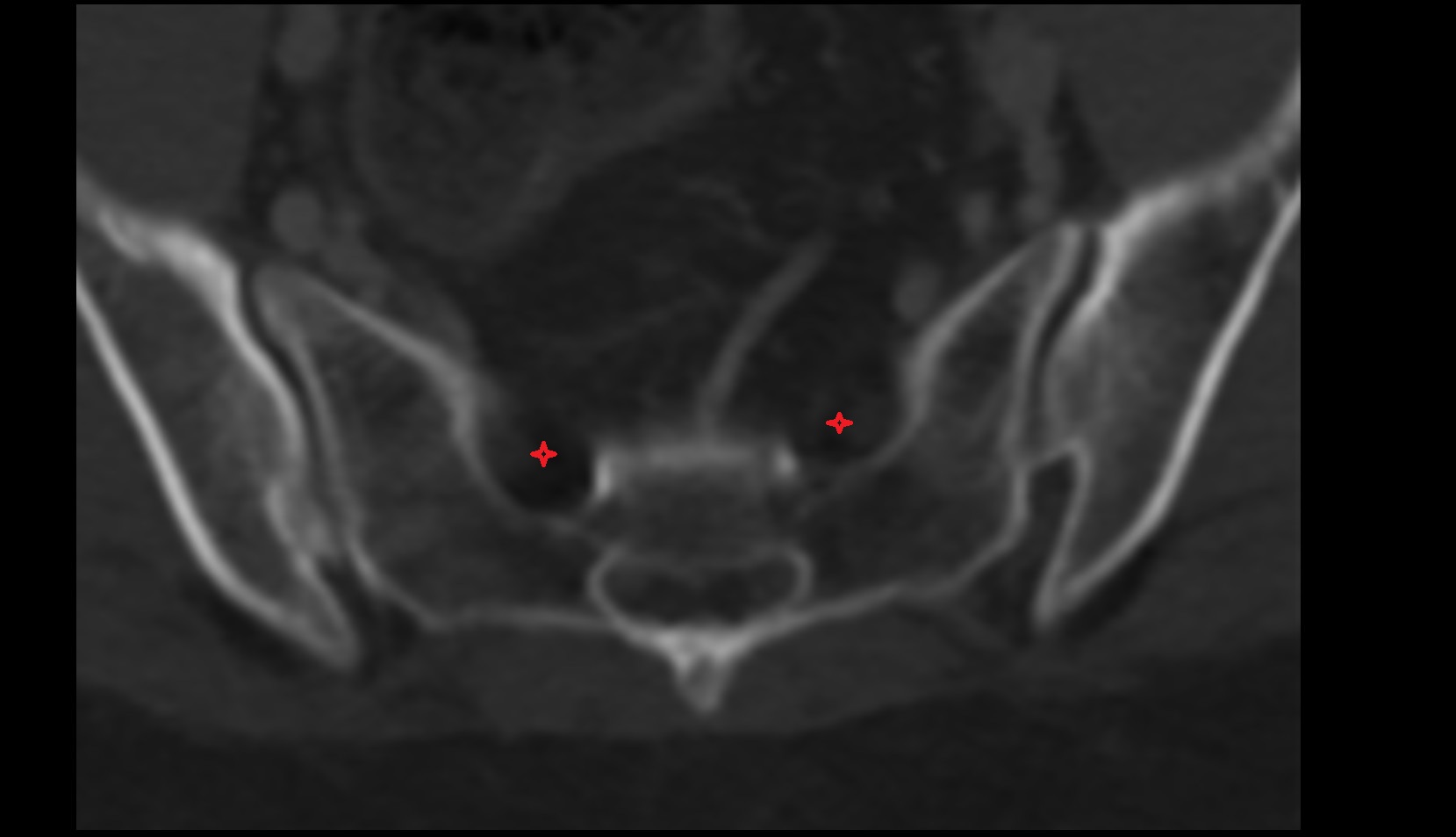 Anterior sacral foramina ct axial image