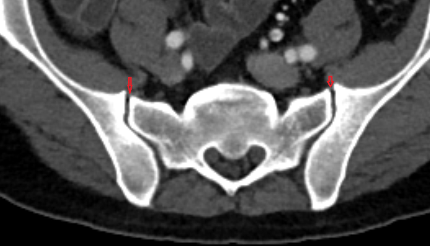 Anterior sacroiliac ligament ct axial image