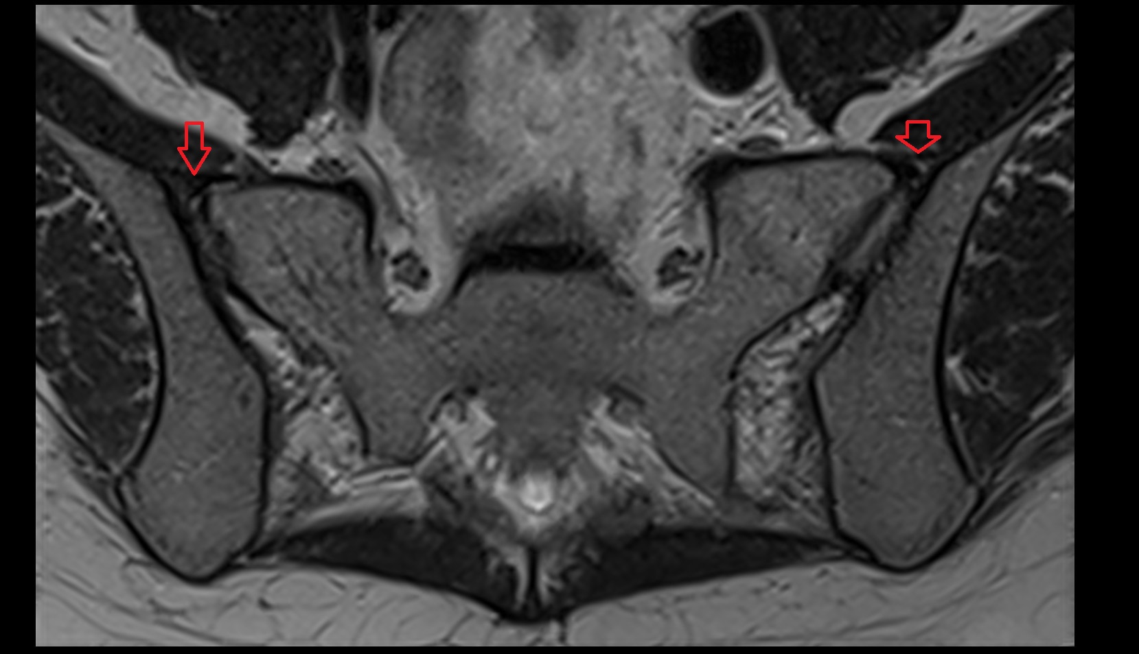 Anterior sacroiliac ligament mri axial image