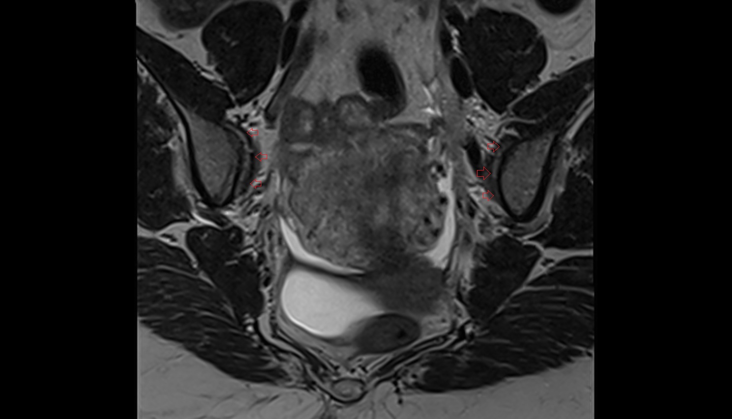 Anterior sacroiliac ligament mri mri coronal  anatomy  image-img-00000-00000