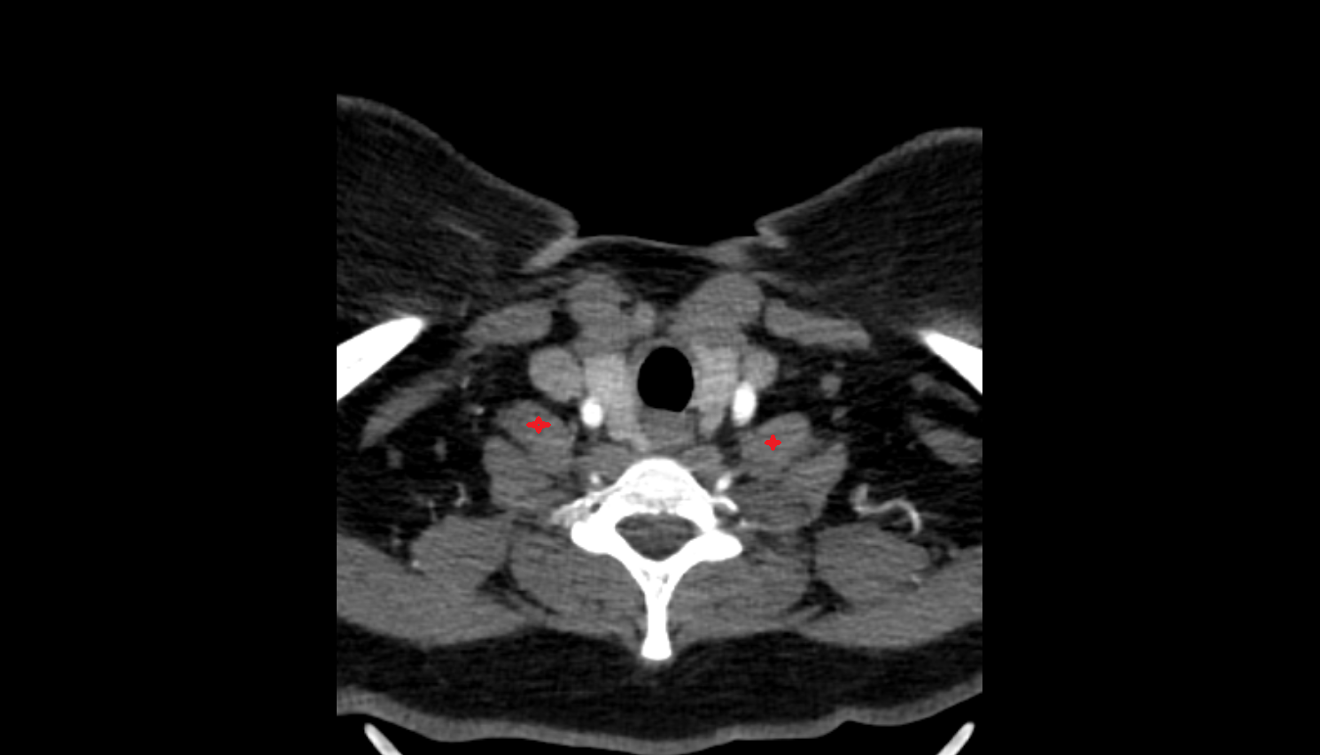 Anterior scalene muscle CT axial  image-img-00000-00000