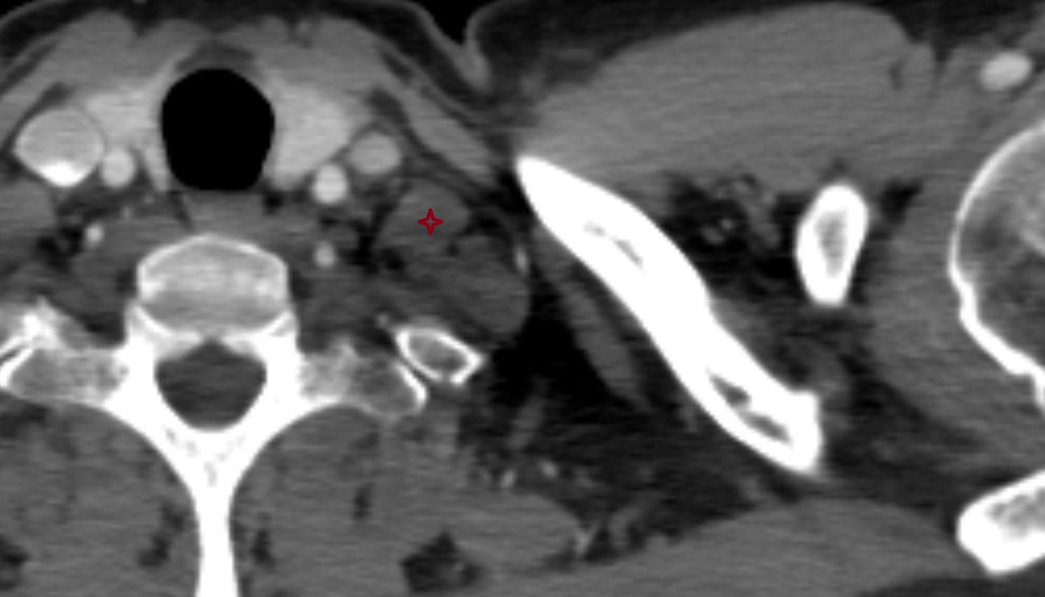 Anterior scalene muscle  anatomy CT axial  image -img-00000-00000