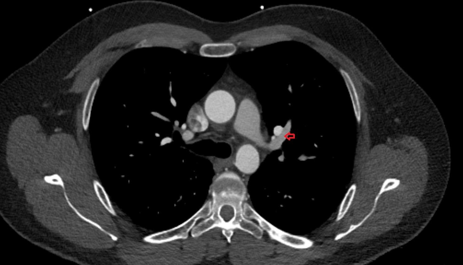 Anterior segmental artery of left lung  anatomy ct axial  image -img-00000-00000