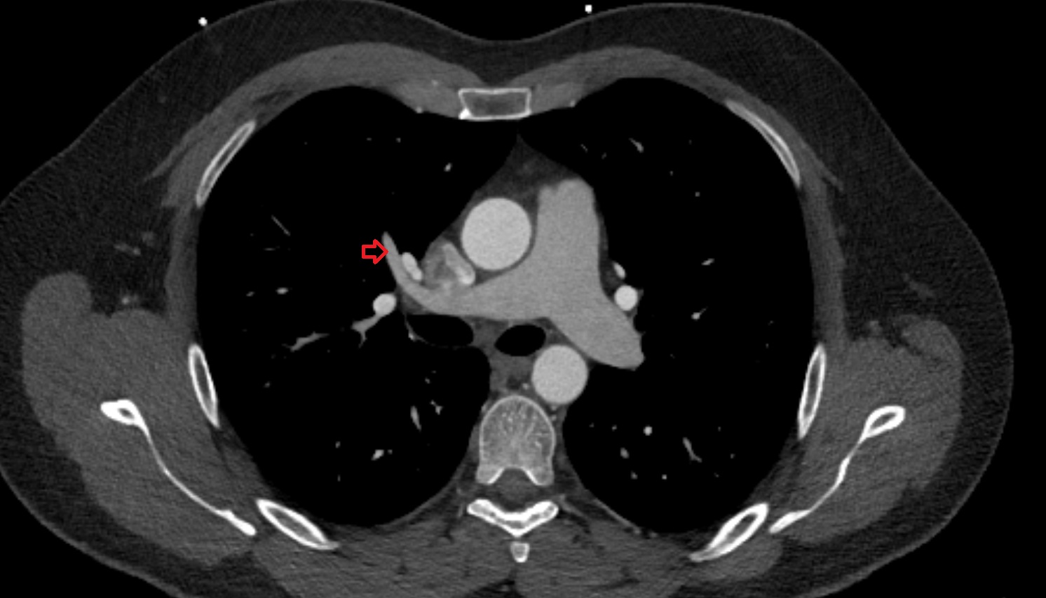 Anterior segmental artery of right lung   anatomy ct axial  image -img-00000-00000