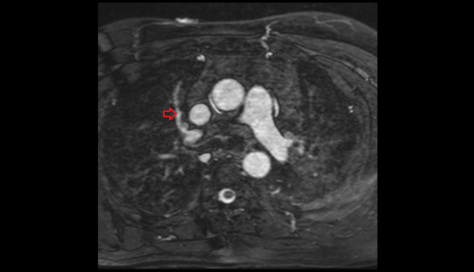 Anterior segmental artery of right lung  mri axial image