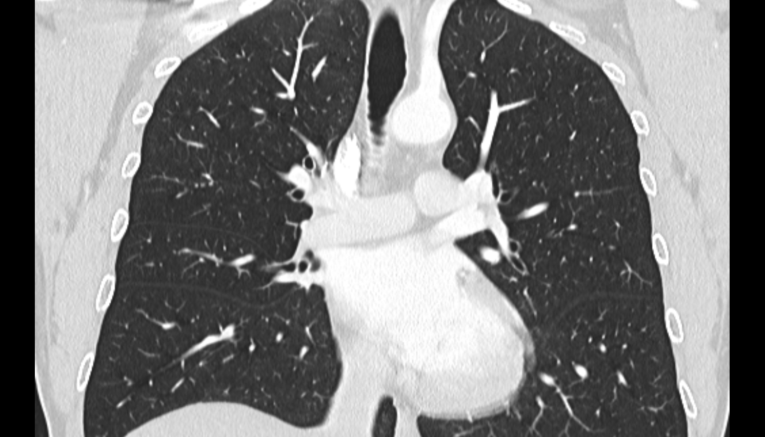 Anterior segmental bronchus of right lung  anatomy CT coronal  image -img-00000-00000