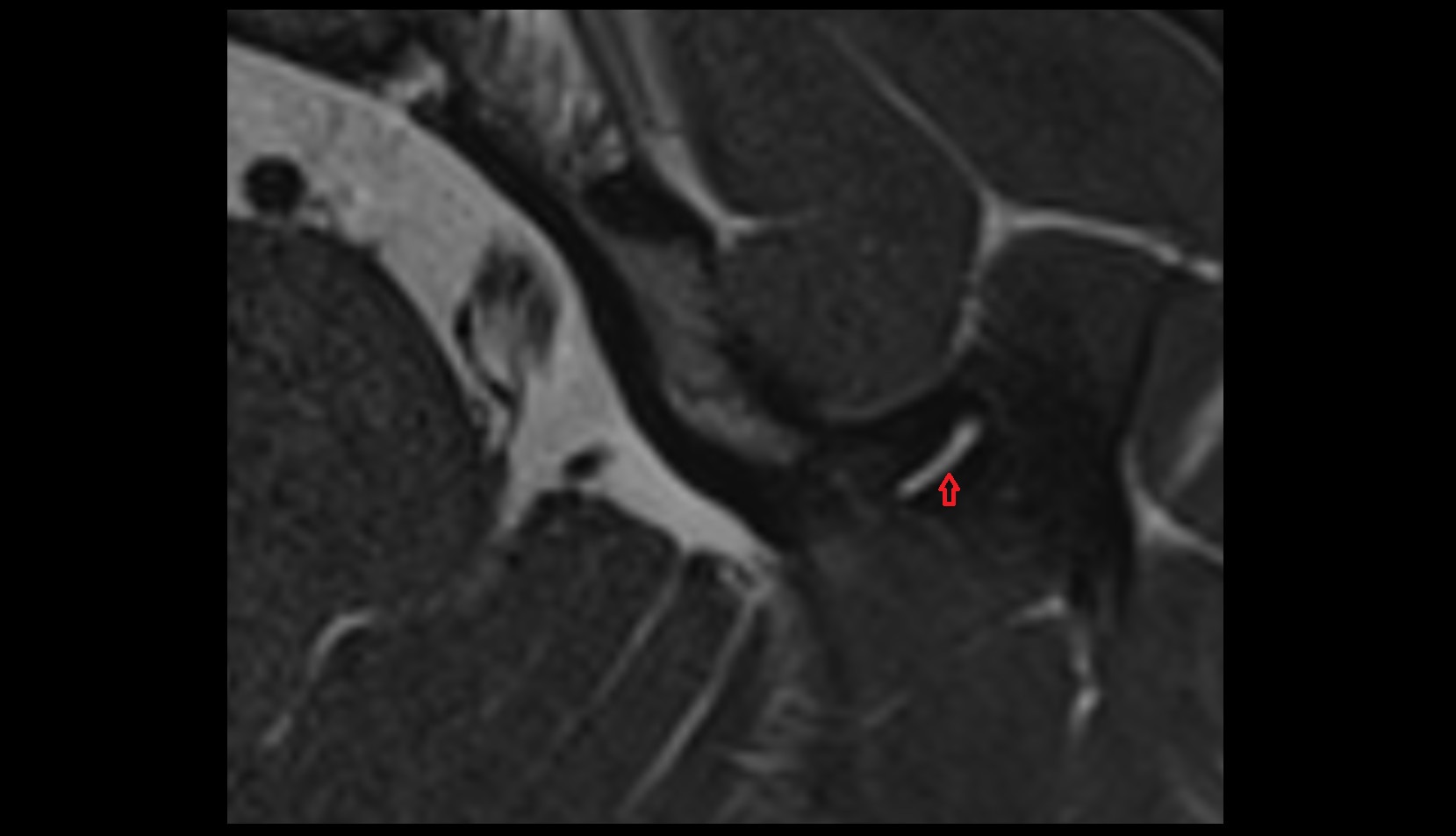 Anterior semicircular canal mri axial image 1