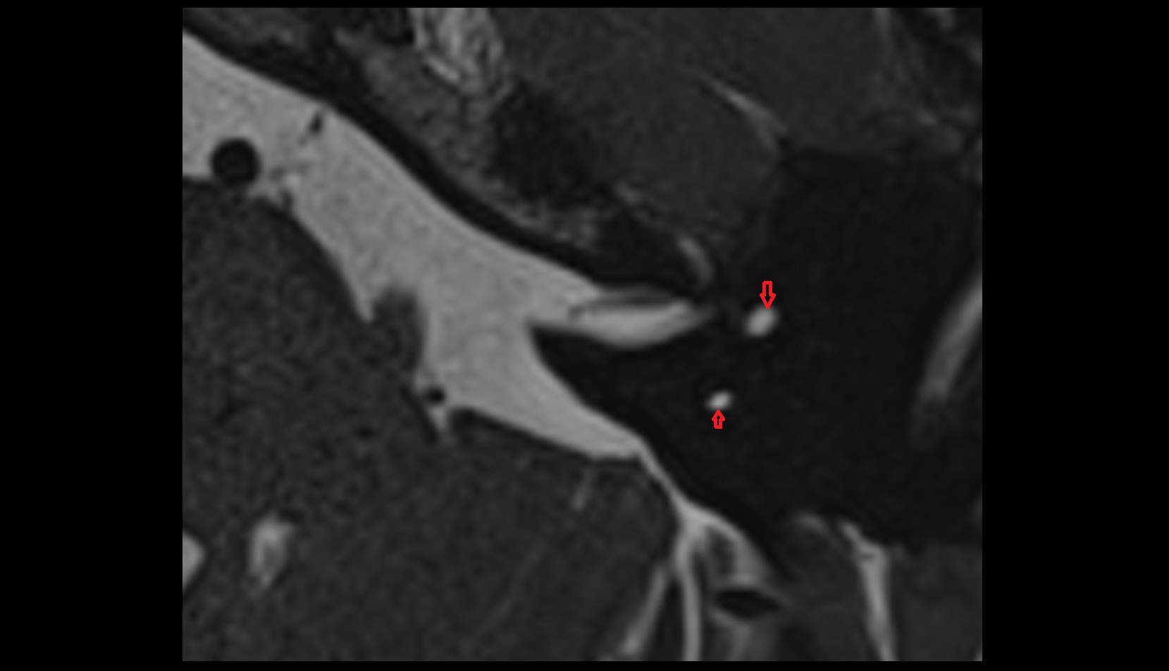 Anterior semicircular canal mri axial image 2