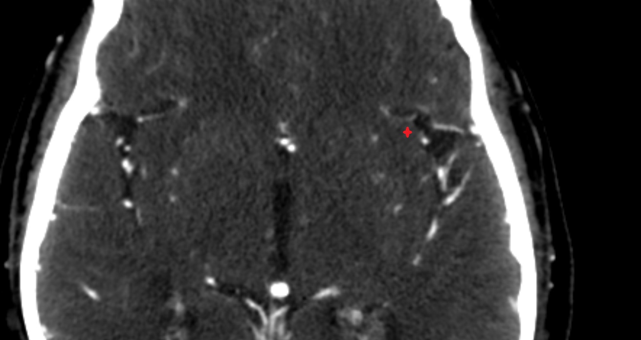 Anterior short insular gyrus CT axial anatomy image -img-00001-00001