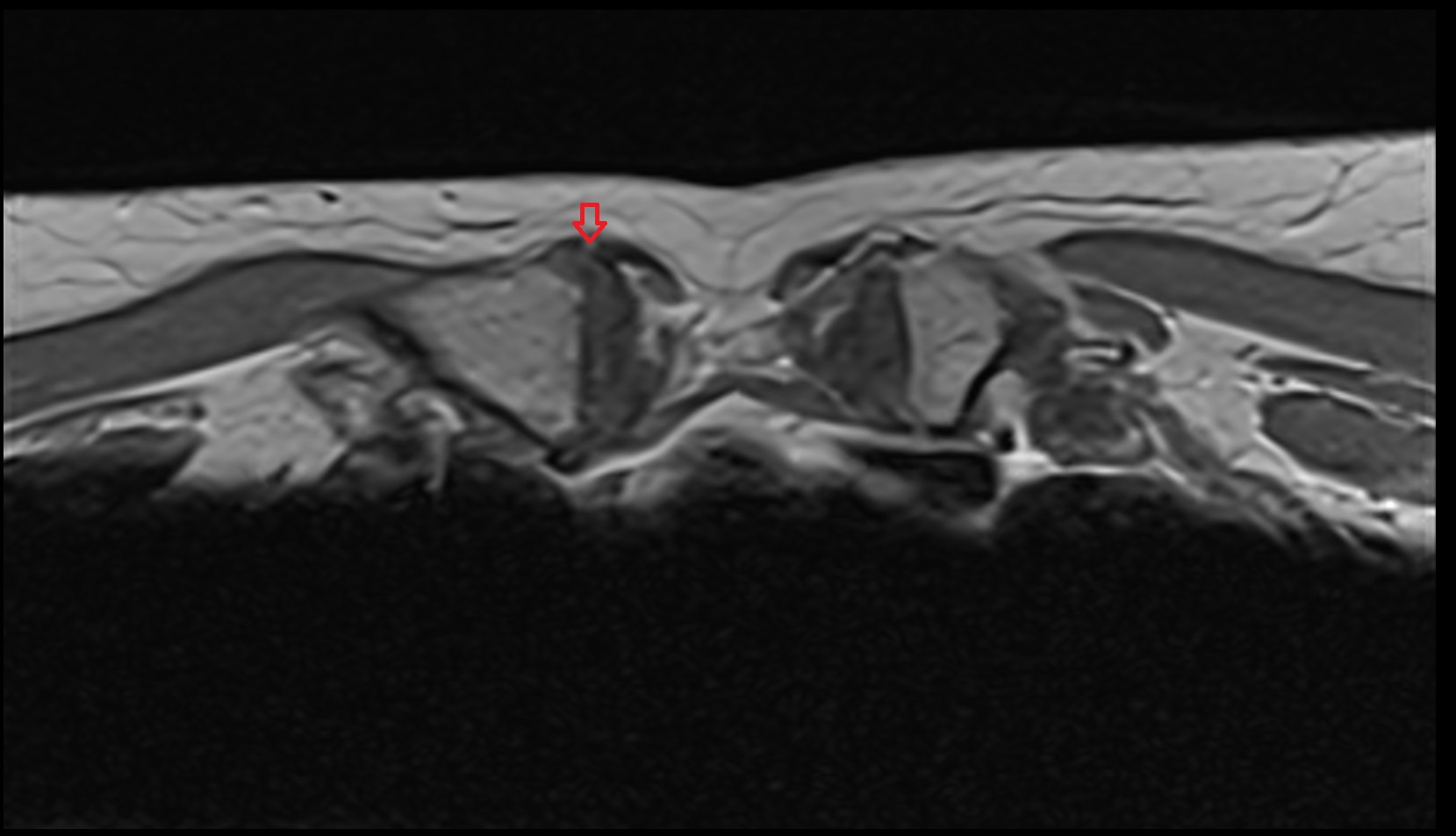 Anterior sternoclavicular ligament axial mri