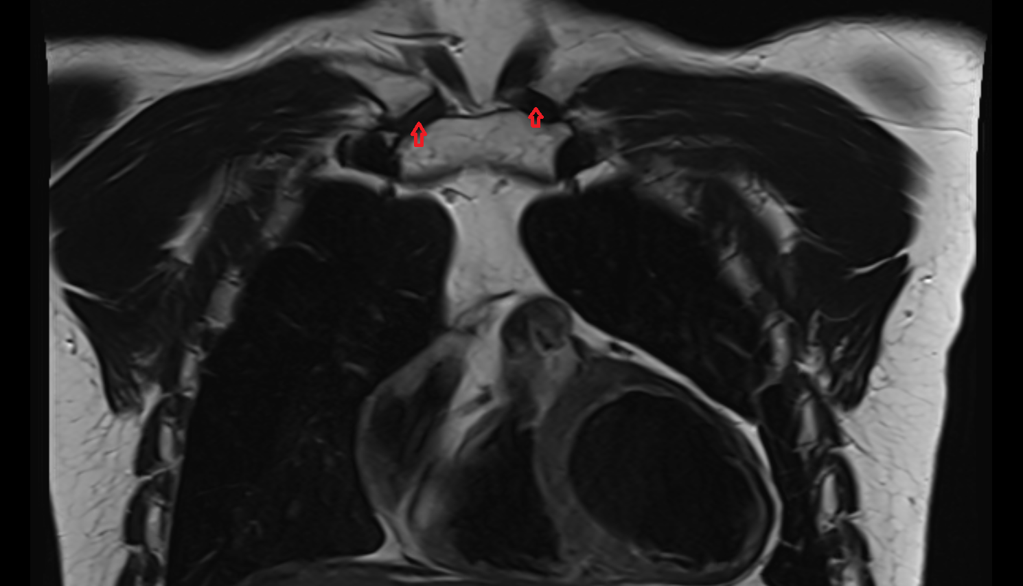 Anterior sternoclavicular ligament coronal MRI  image-img-00000-00000