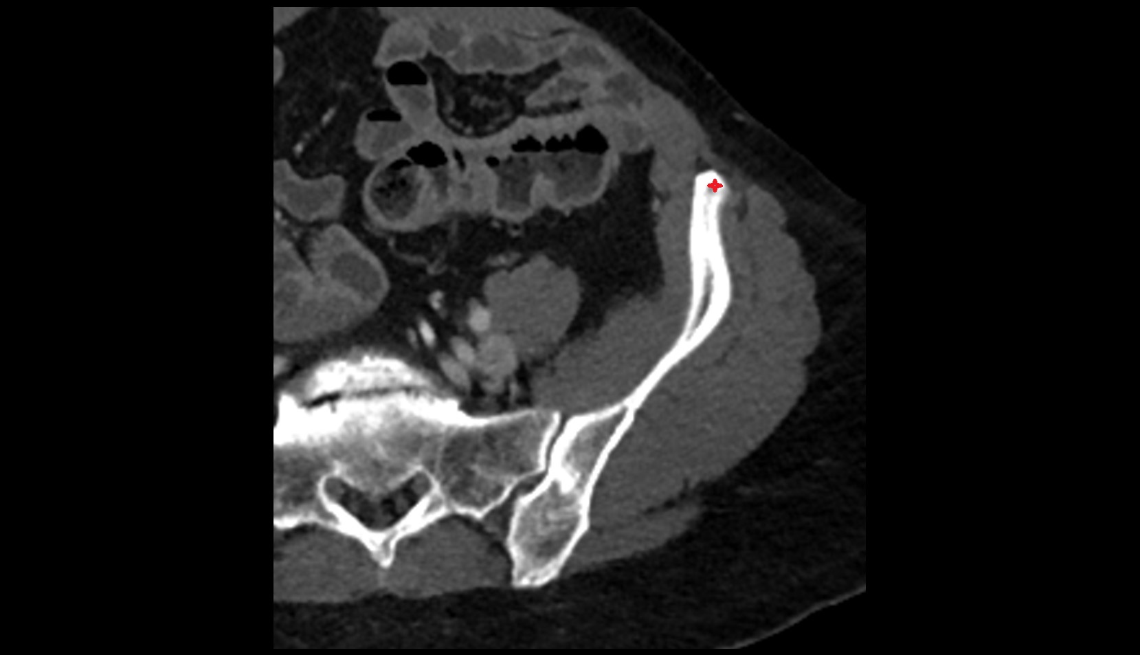 Anterior superior iliac spine CT axial image