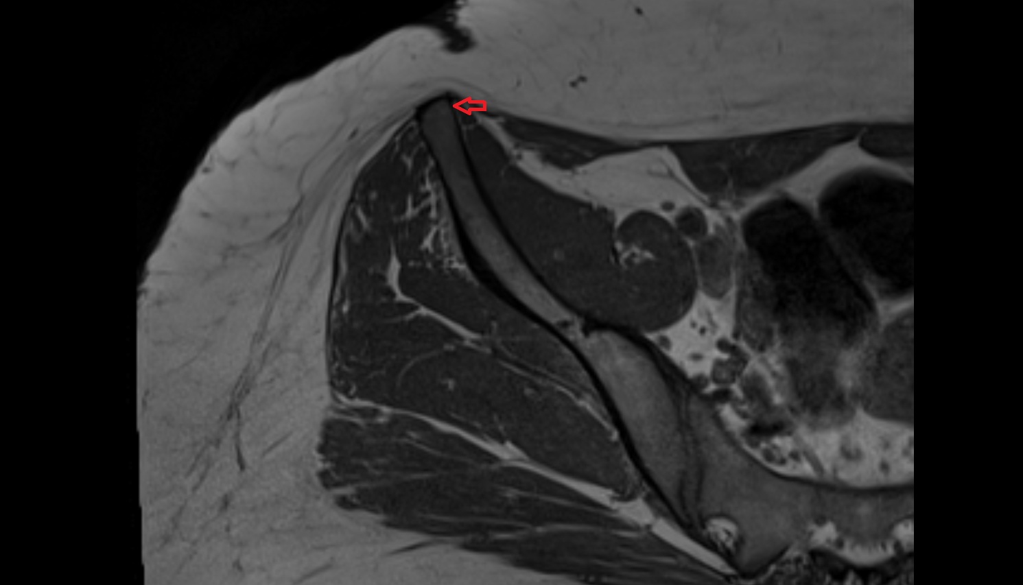 Anterior superior iliac spine  MRI  axial  anatomy  image-img-00000-00000