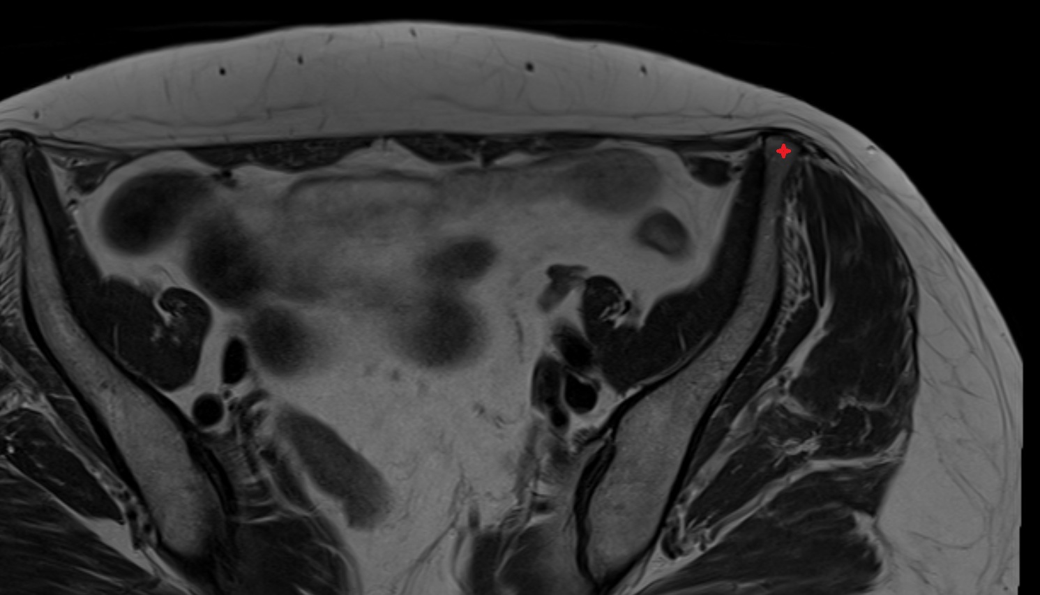 Anterior superior iliac spine spine MRI  axial  anatomy  image-img-00000-00000_00001