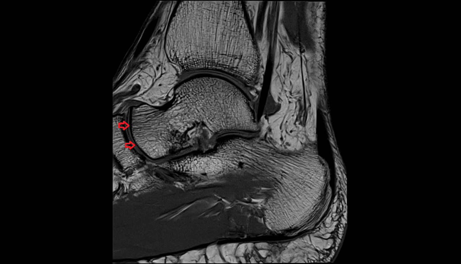 Anterior talar articular surface  mri  anatomy labelled image-img-00000-00000
