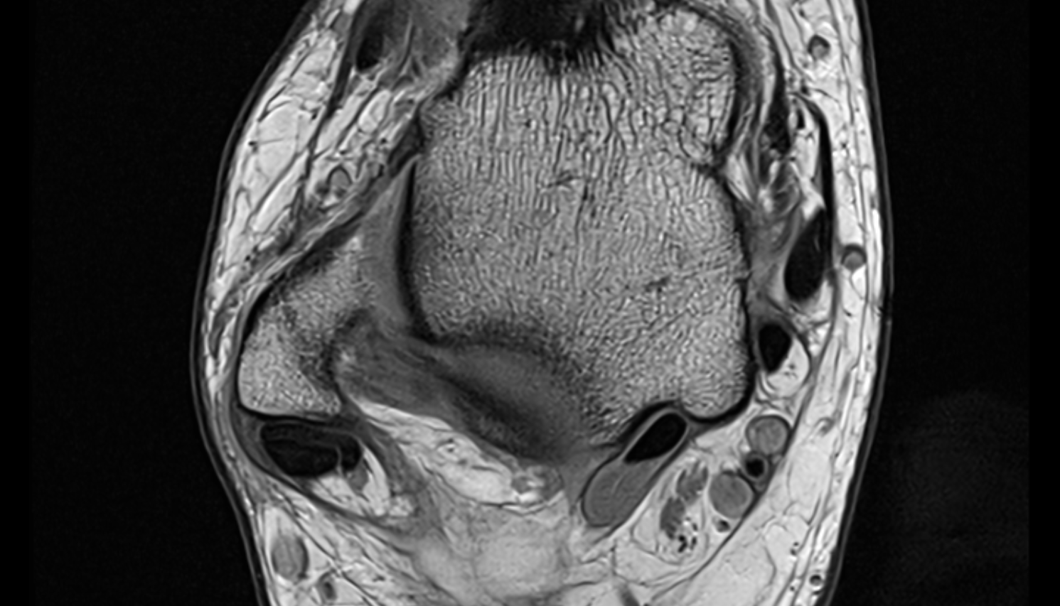 Anterior talofibular ligament axial cross sectional anatomy 3T MRI AI enhanced radiology image-img-00000-00000
