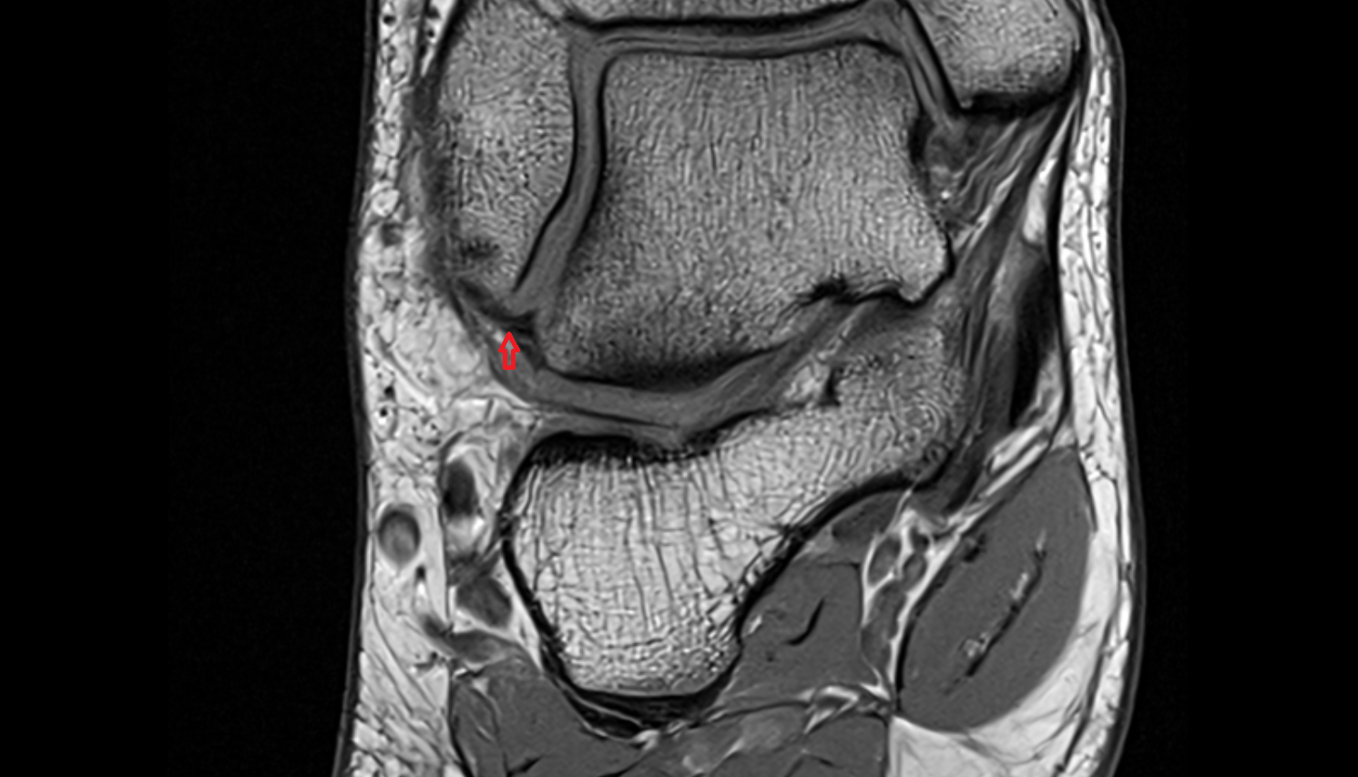 Anterior talofibular ligament  coronal cross sectional anatomy 3T MRI AI enhanced radiology image-img-00000-00000