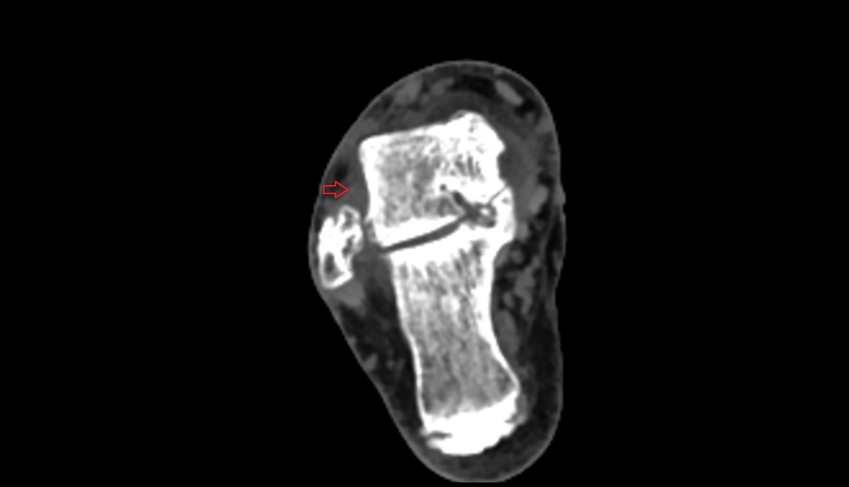 Anterior talofibular ligament ct axial image