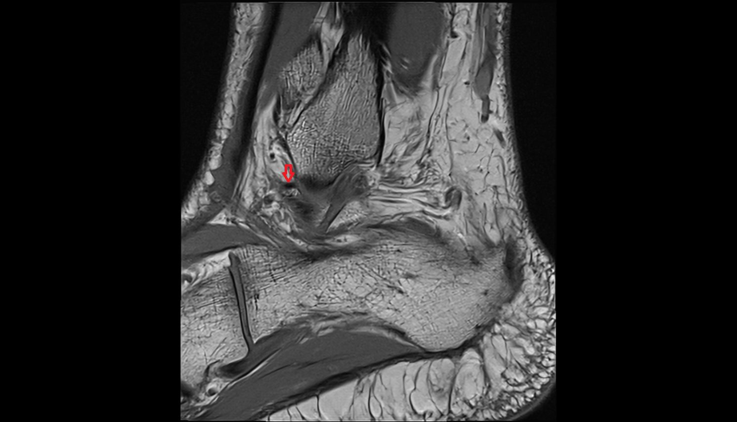 Anterior talofibular ligament  sagittal cross sectional anatomy 3T MRI AI enhanced radiology image-img-00000-00000