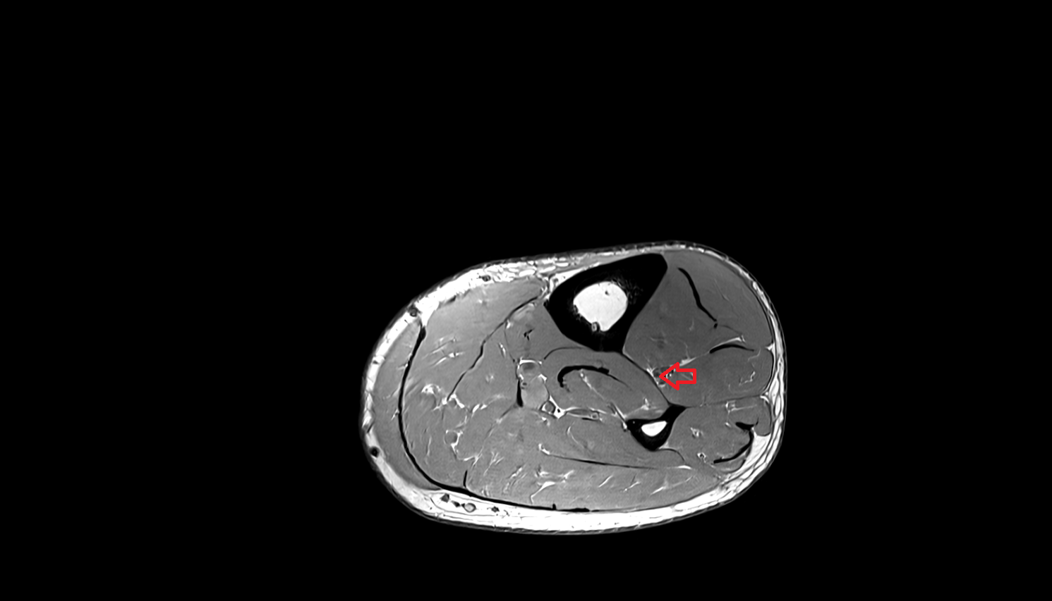 Anterior tibial artery axial  cross sectional anatomy 3T MRI AI enhanced radiology image-img-00000-00000_00001
