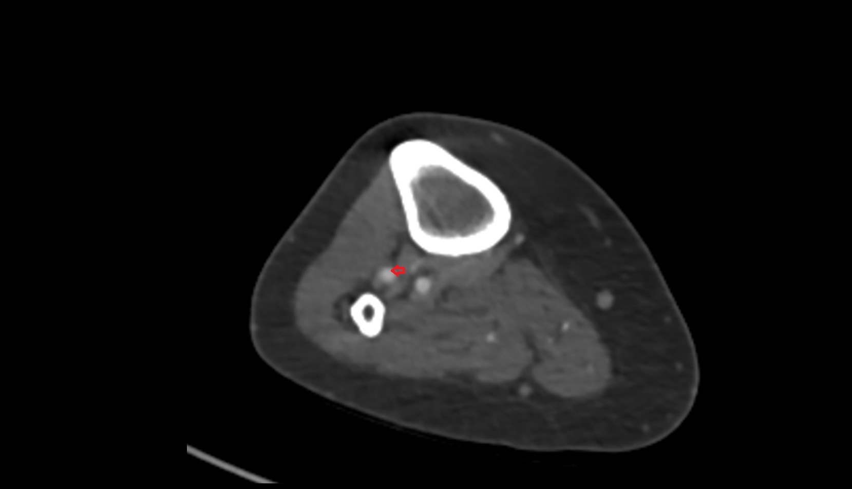 Anterior tibial artery ct axial 0