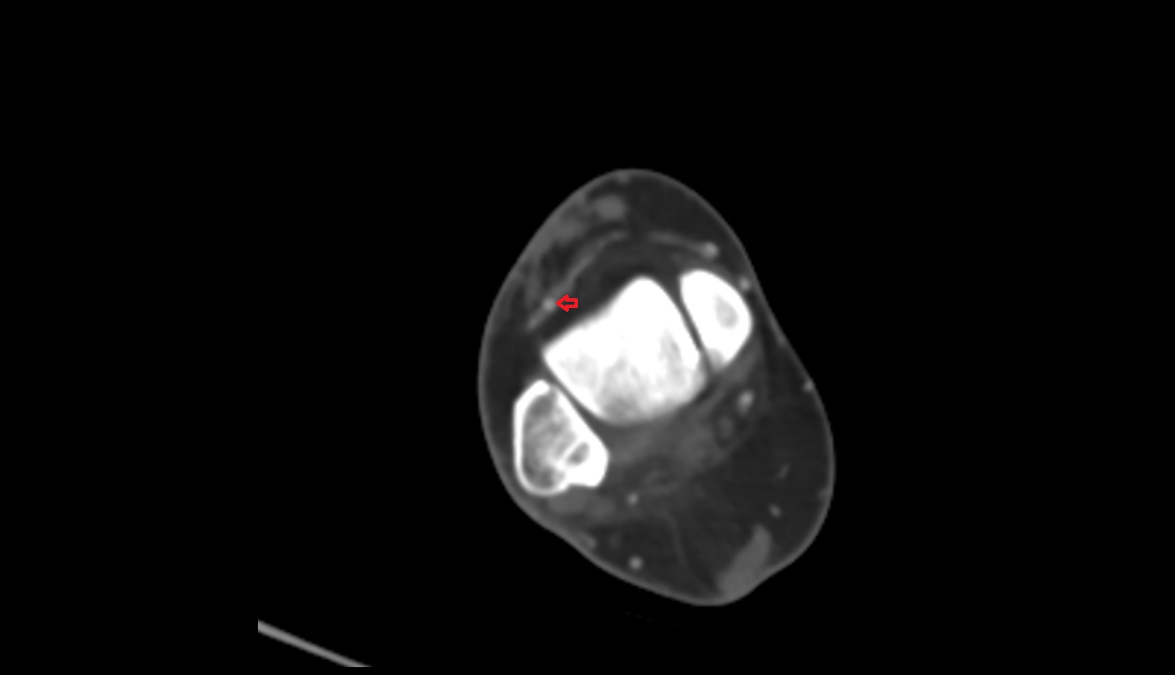 Anterior tibial artery ct axial 2