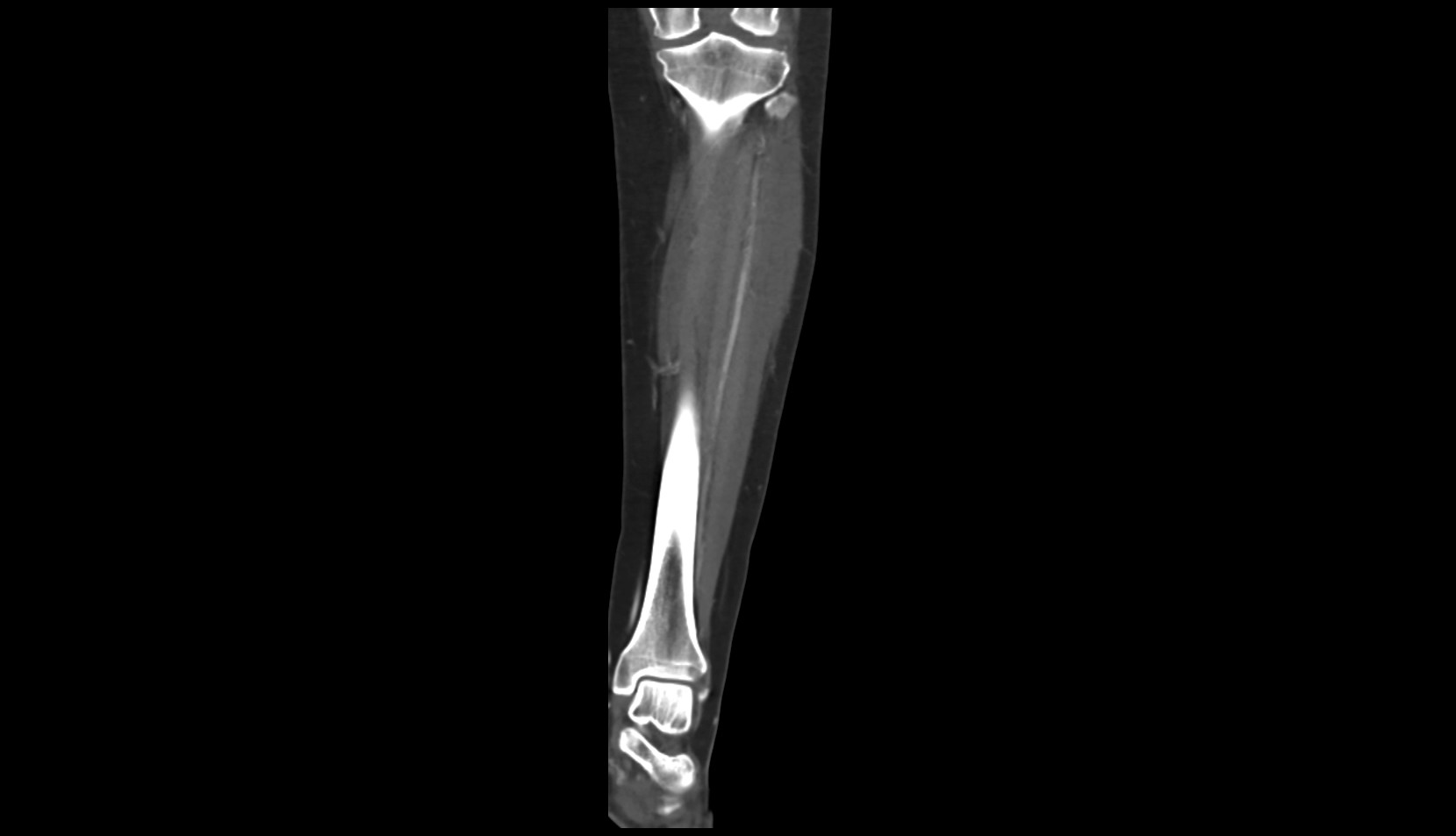 Anterior tibial artery ct coronal