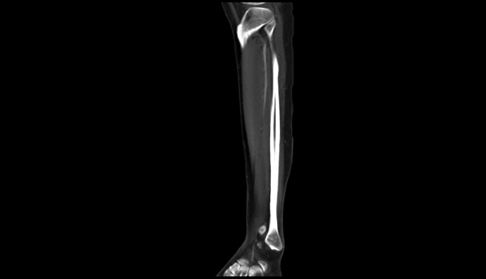 Anterior tibial artery ct sagittal image