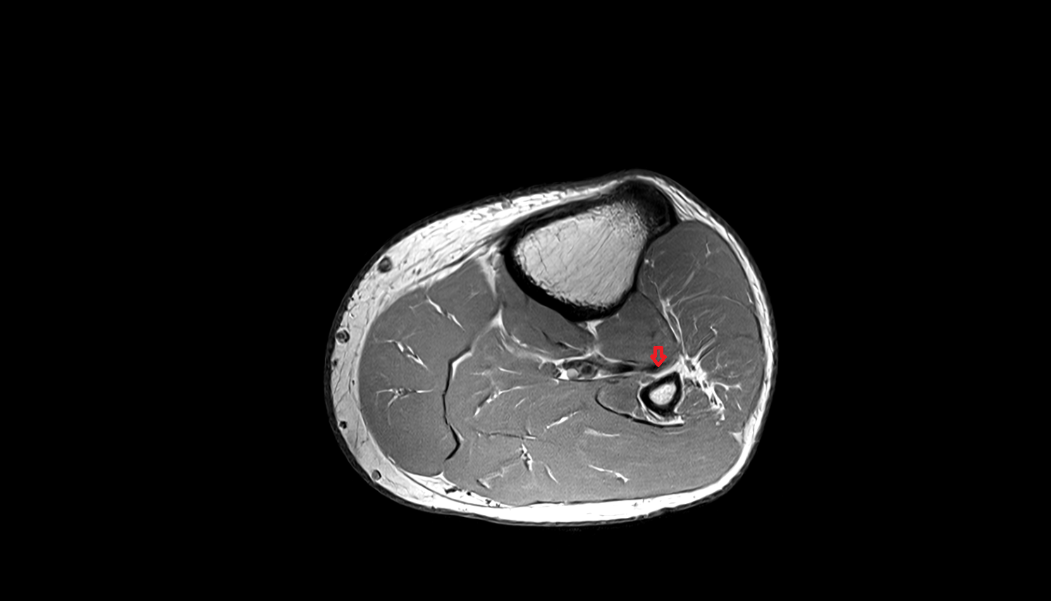 Anterior tibial veins  axial  cross sectional anatomy 3T MRI AI enhanced radiology image-img-00000-00000