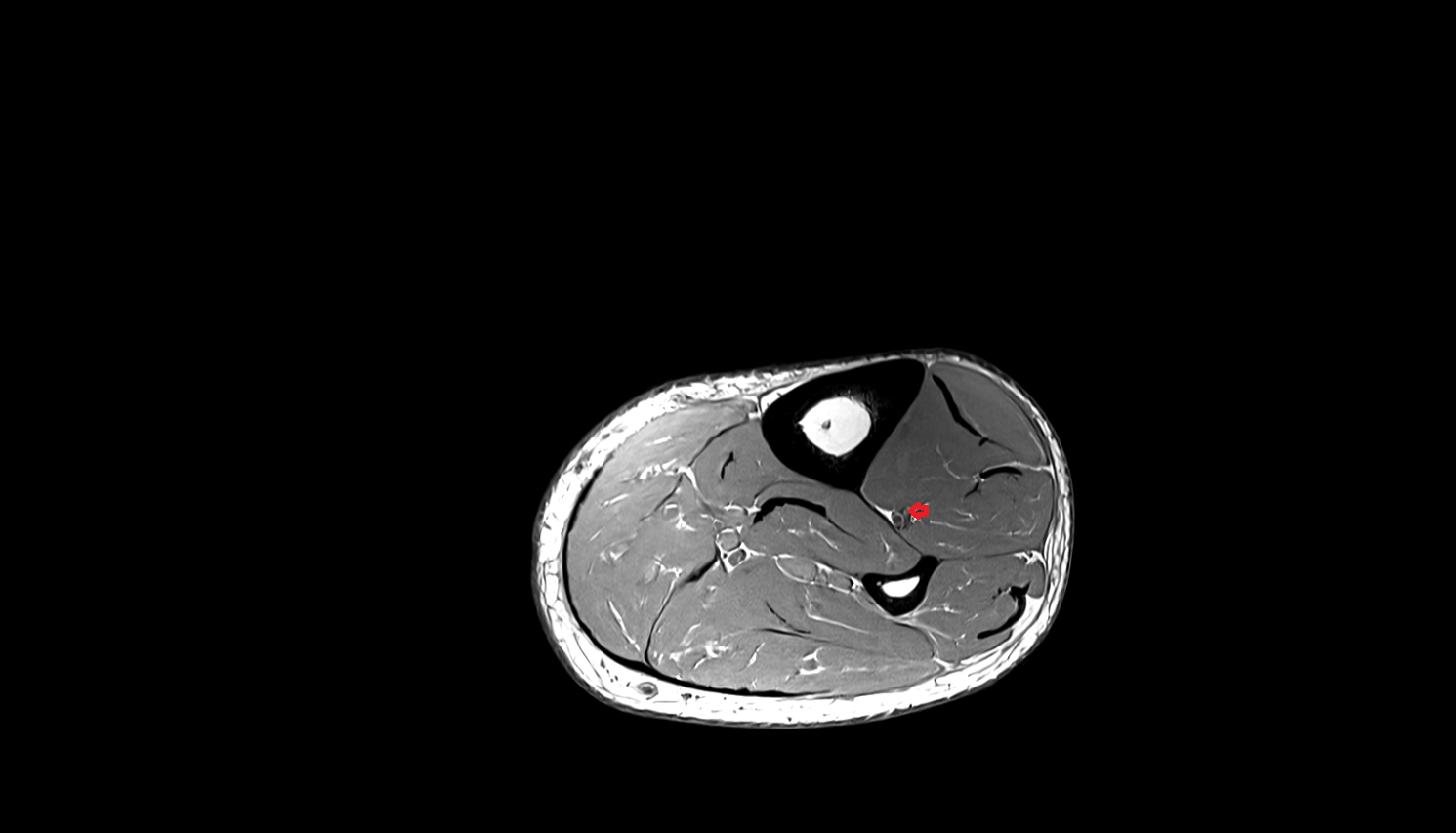 Anterior tibial veins  axial  cross sectional anatomy 3T MRI AI enhanced radiology image-img-00000-00000_00002