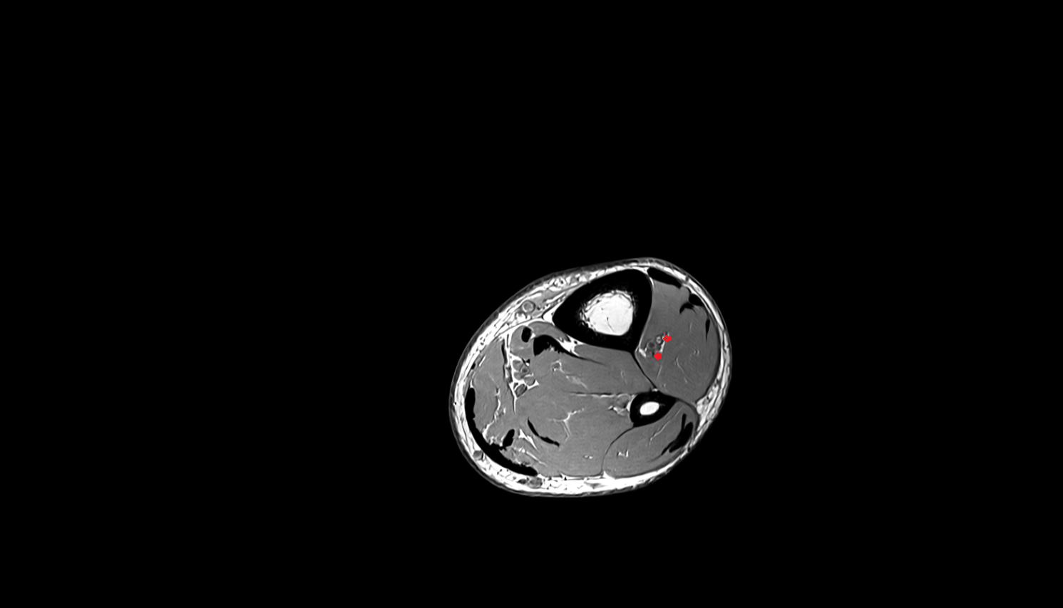 Anterior tibial veins  axial  cross sectional anatomy 3T MRI AI enhanced radiology image-img-00000-00000_00003