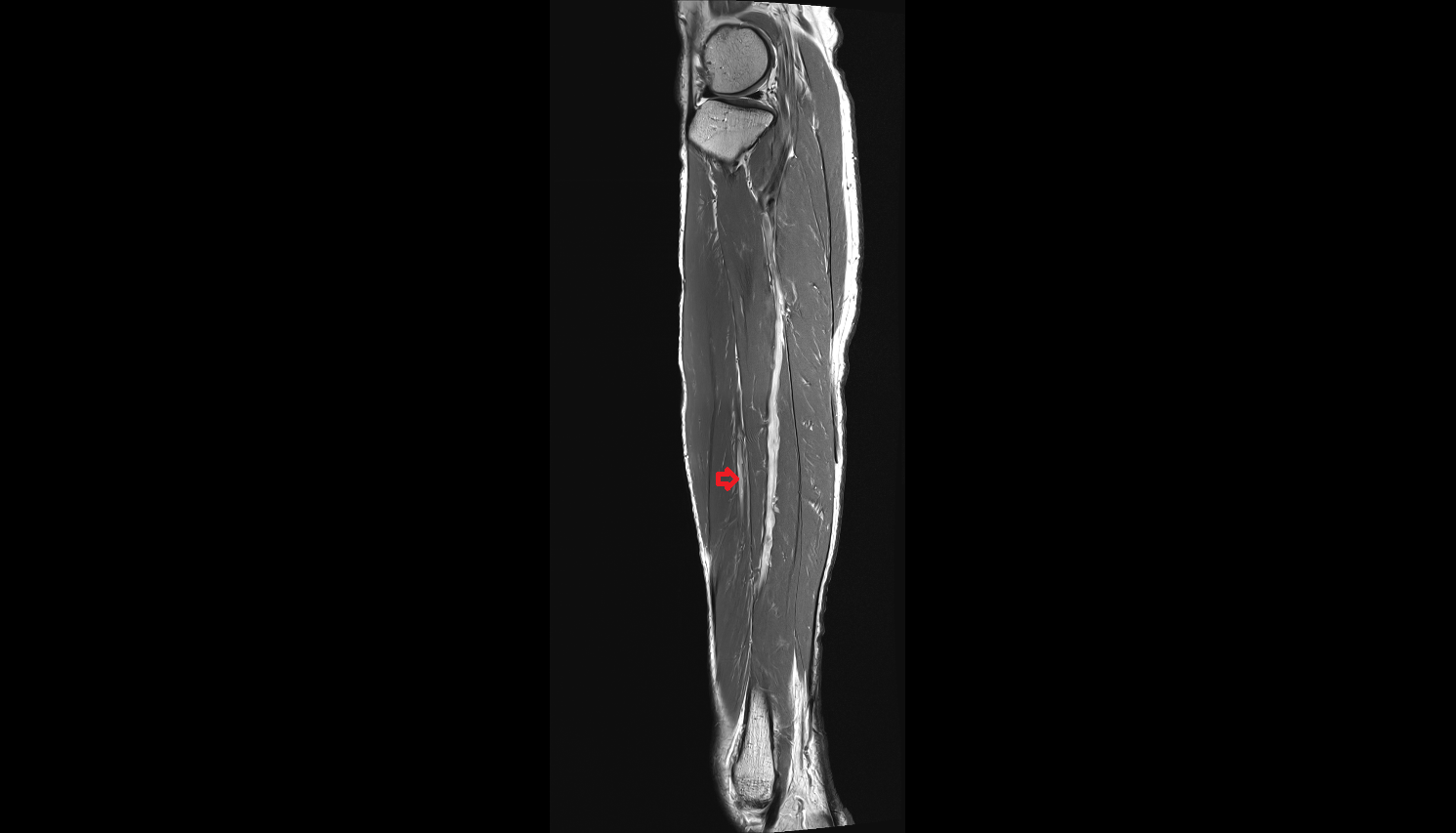 Anterior tibial veins  axial  cross sectional anatomy 3T MRI AI enhanced radiology image-img-00000-00000_00005
