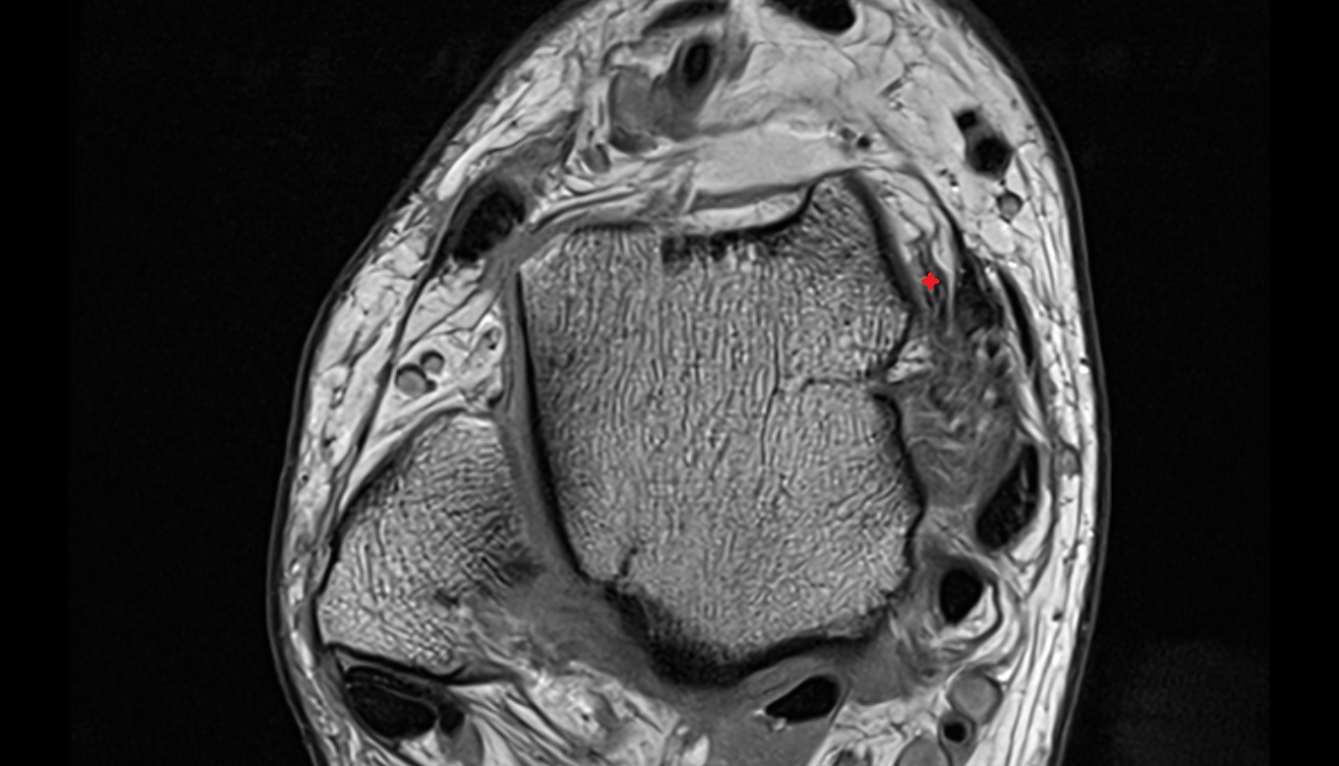 Anterior tibiotalar ligament (Deep Deltoid) axial cross sectional anatomy 3T MRI AI enhanced radiology image-img-00000-00000