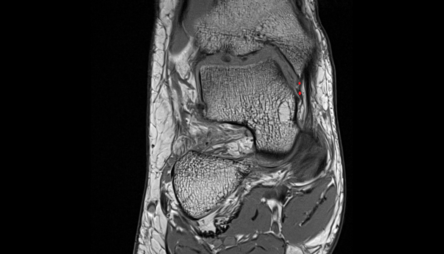Anterior tibiotalar ligament(Deep Deltoid) coronal cross sectional anatomy 3T MRI AI enhanced radiology image-img-00000-00000