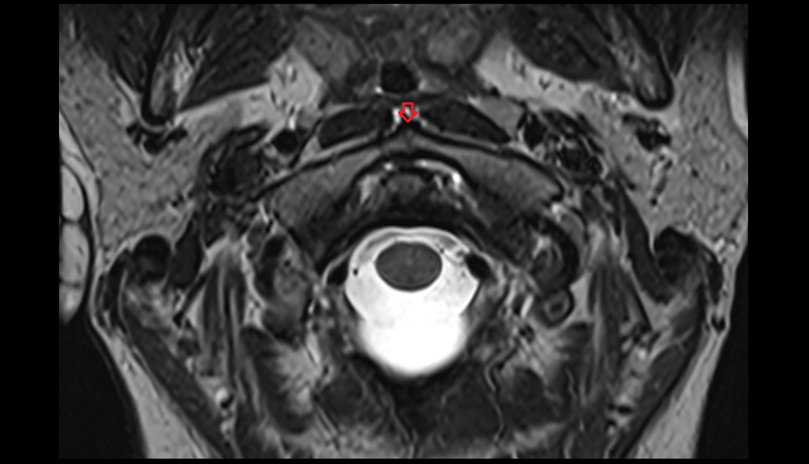 Anterior tubercle of atlas MRI AXIAL IMAGE