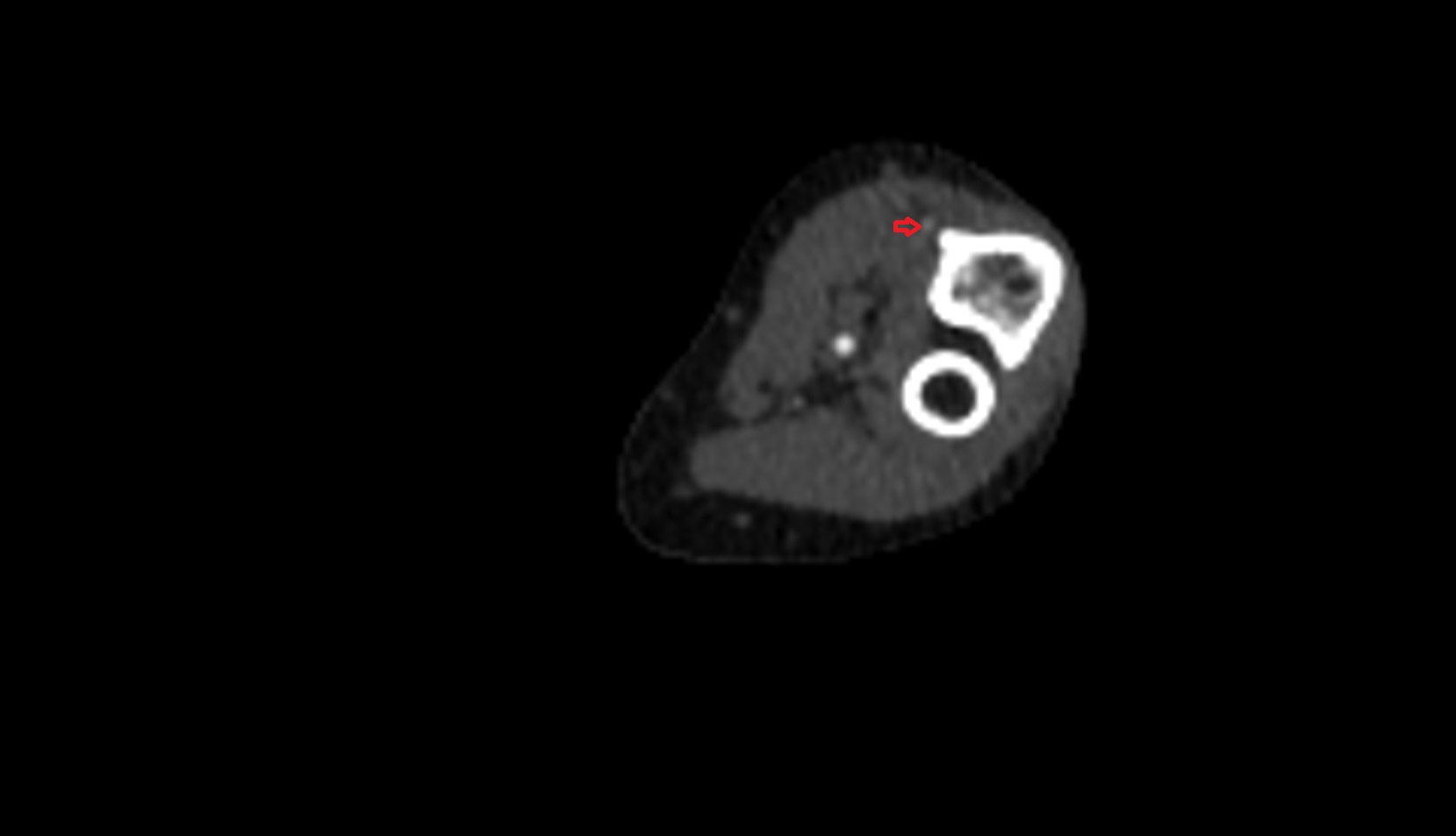 Anterior ulnar recurrent artery