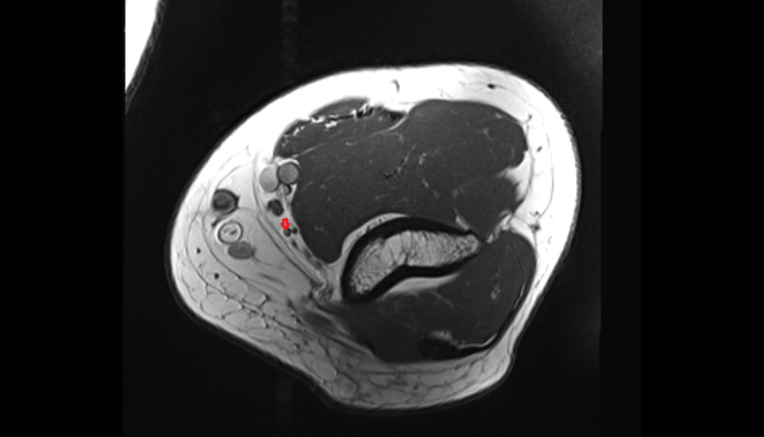 Anterior ulnar recurrent artery axial cross sectional anatomy 3T MRI AI enhanced radiology image -img-00000-00000