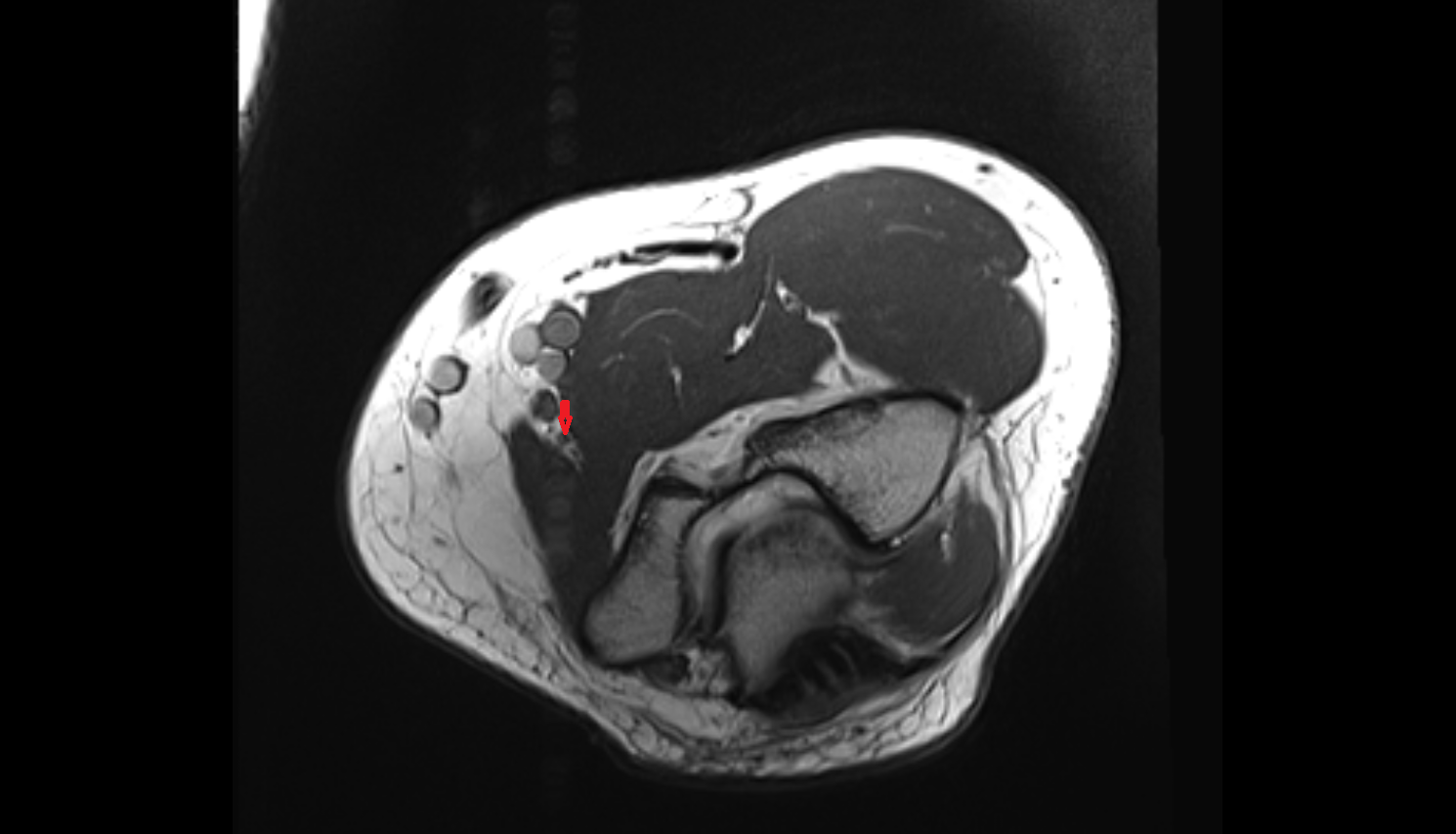 Anterior ulnar recurrent artery axial cross sectional anatomy 3T MRI AI enhanced radiology image -img-00000-00000_00001
