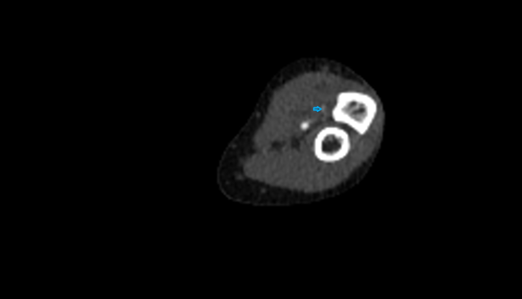 Anterior ulnar recurrent artery ct axial