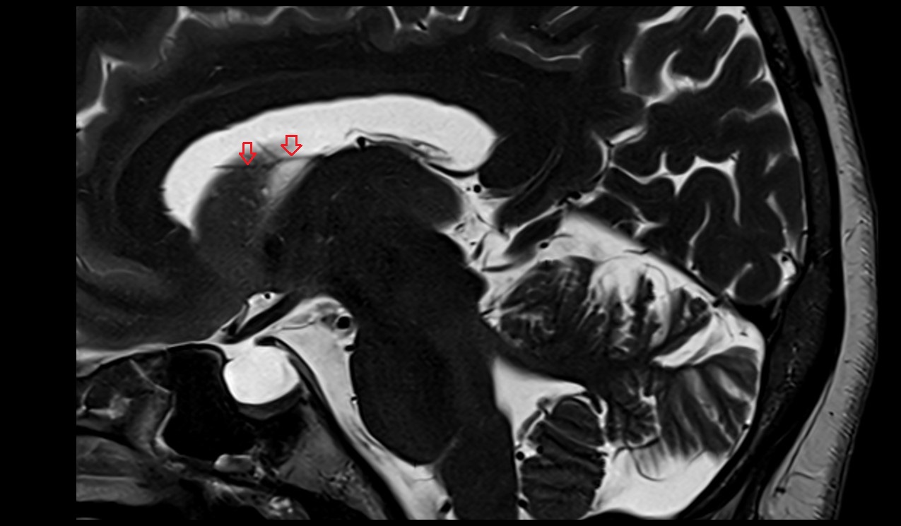 Anterior vein of caudate nucleus MRI 3T sagittal image