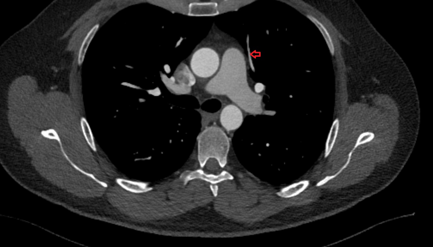 Anterior vein of left lung  CT axial image -img-00000-00000