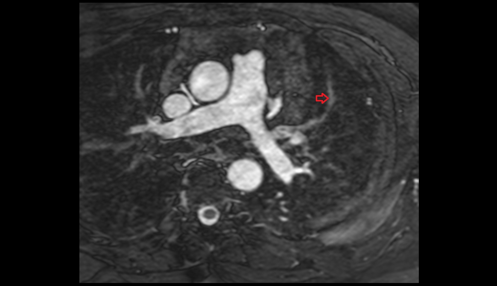 Anterior vein of left lung MRI AXIAL IMAGE