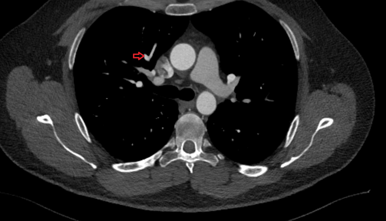 Anterior vein of right lung  CT axial image -img-00000-00000