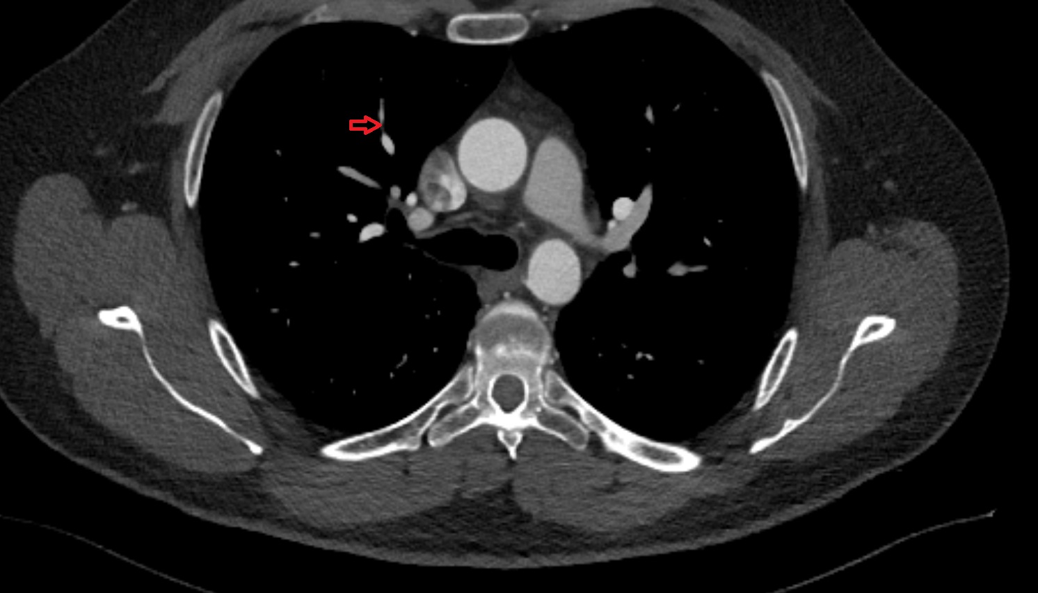 Anterior vein of right lung  CT axial image -img-00000-00000_00001